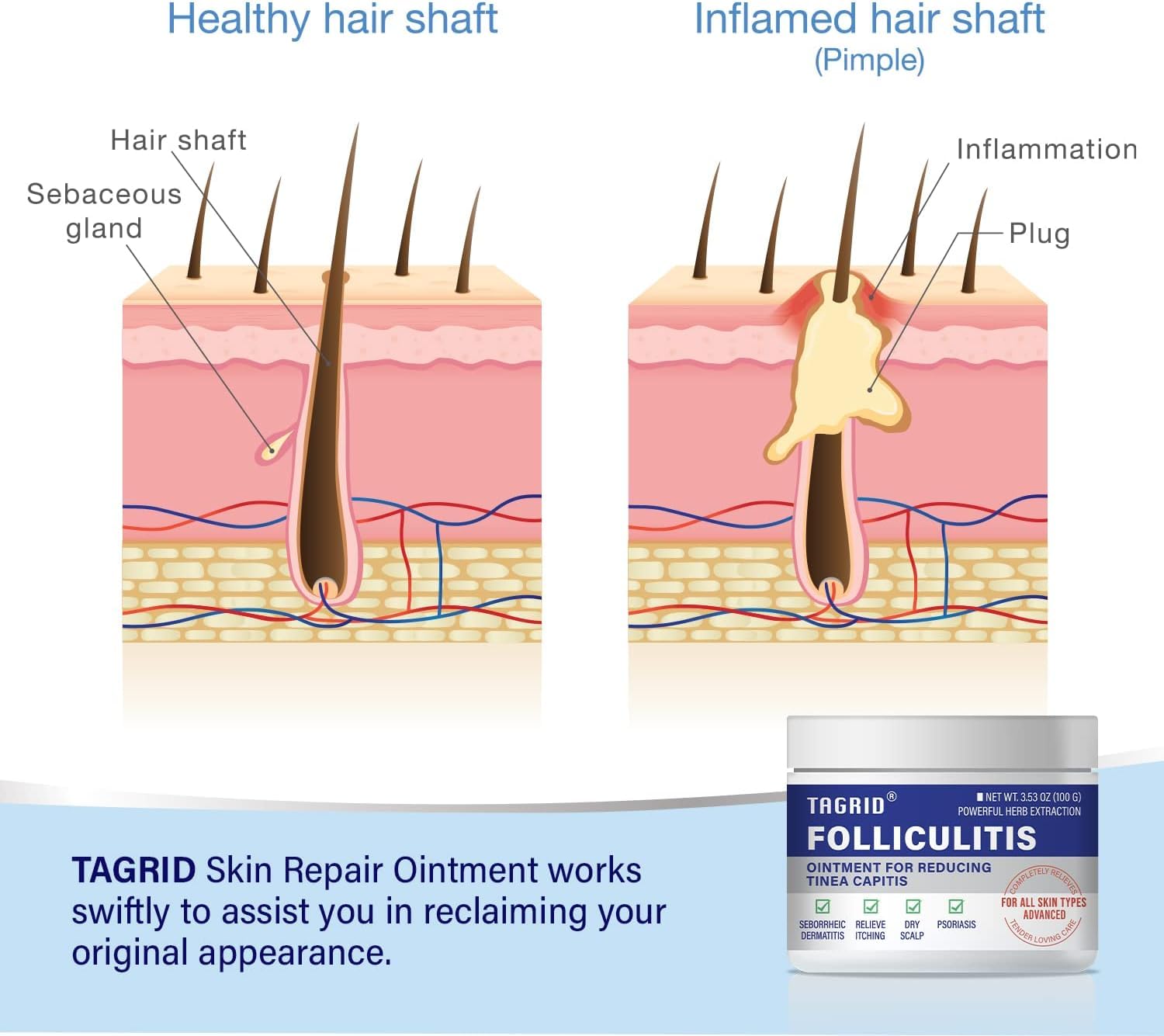 TAGRID Folliculitis Treatment Cream - 7X Fast, Ingrown Hair Treatment, Soothing Scalp, Face & Body Cream - Hydrating & Refreshing - 100g