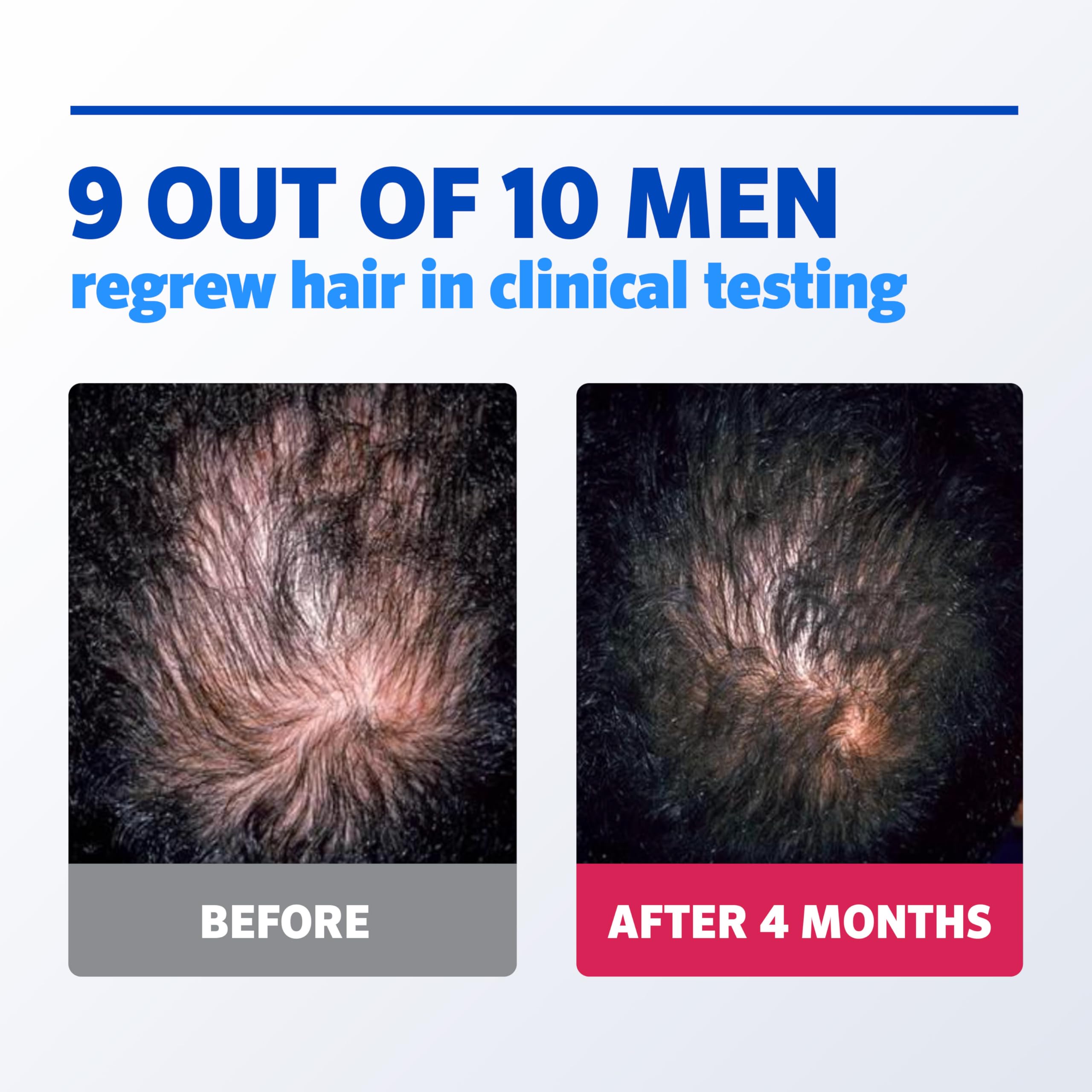 Men's Rogaine 5% Minoxidil for Men Foam, Clinically Proven Regrowth for Thinning Hair, Topical Hair Loss Treatment, Unscented Topical Aerosol, Results in 8-16 Weeks, 3-Month Supply, 3 x 2.11 oz